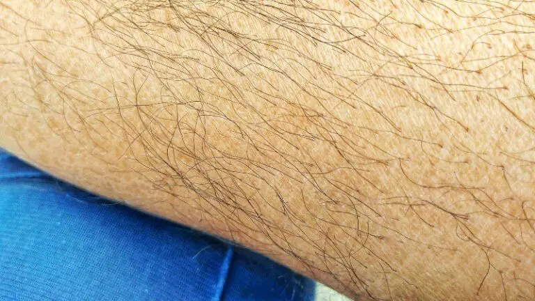 Can Laser Hair Removal Cause More Hair?