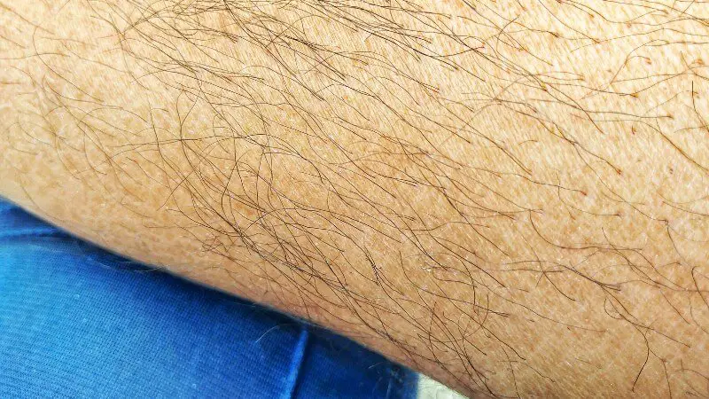 can laser hair removal cause more hair