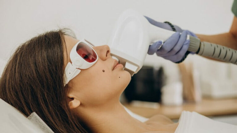Can You Use Laser Hair Removal on Moles?