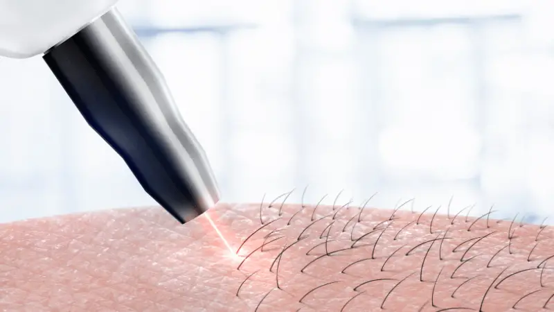 One type of laser hair removal - can laser hair removal cause more hair growth