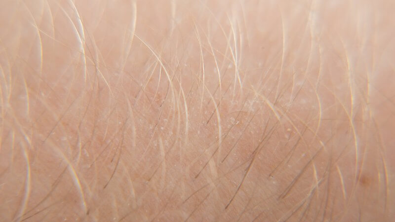 blonde hair on arm - Can Laser Hair Removal Cause More Hair