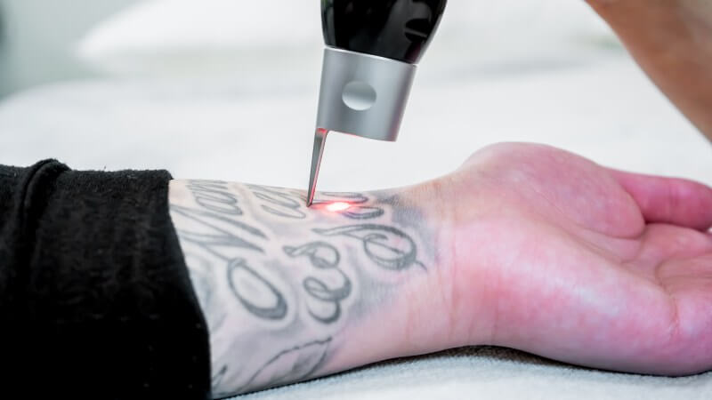 can you get laser hair removal with tattoos