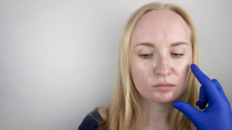 woman with skin acne having laser hair removal consultation